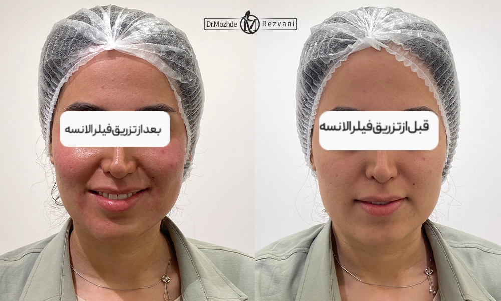 نمونه کار تزریق فیلر الانسه