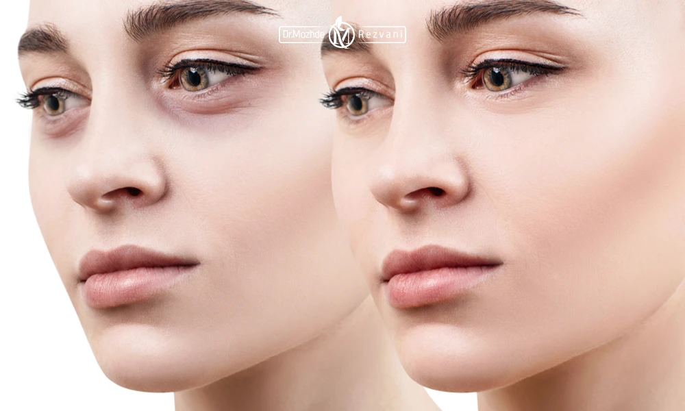 قبل و بعد از تزریق فیلر زیر چشم