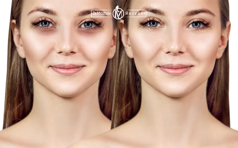 تزریق فیلر الانسه برای زیر چشم