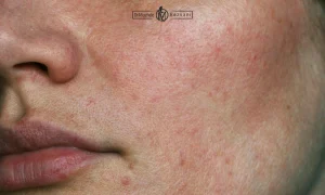 درمان چربی صورت و جوش