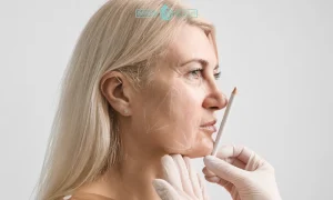 لیفت با نخ سیلوئت | مراقبت بعد از لیفت نخ سیلوئت