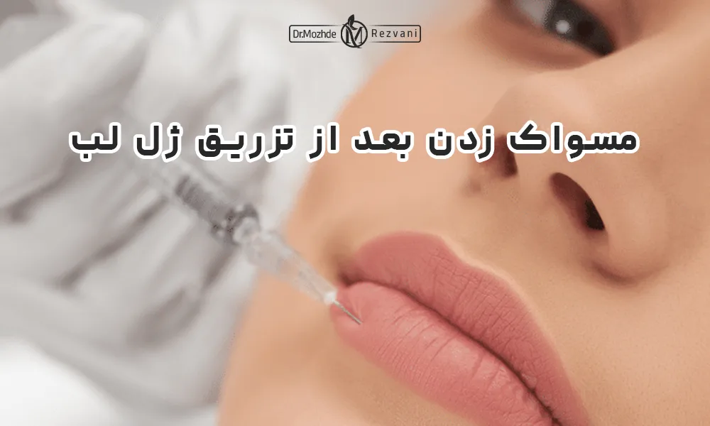 تزریق ژل لب به لب پایینی یک خانمی که دراز کشیده است.