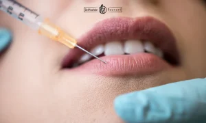 تزریق فیلر لب در پریودی برای یک خانم