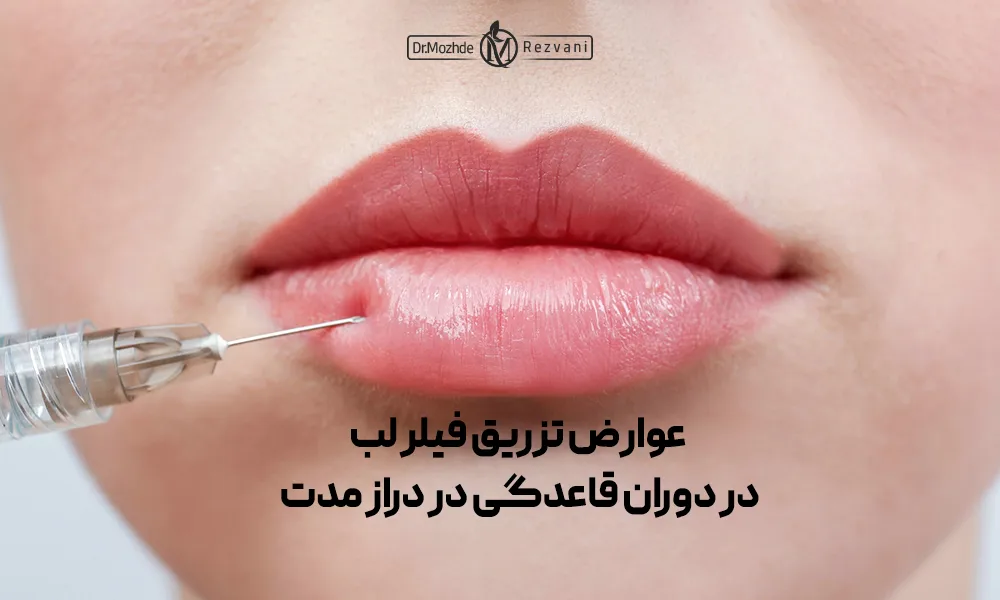وارد کردن سرنگ فیلر برای تزریق فیلر لب در پریودی یک خانم