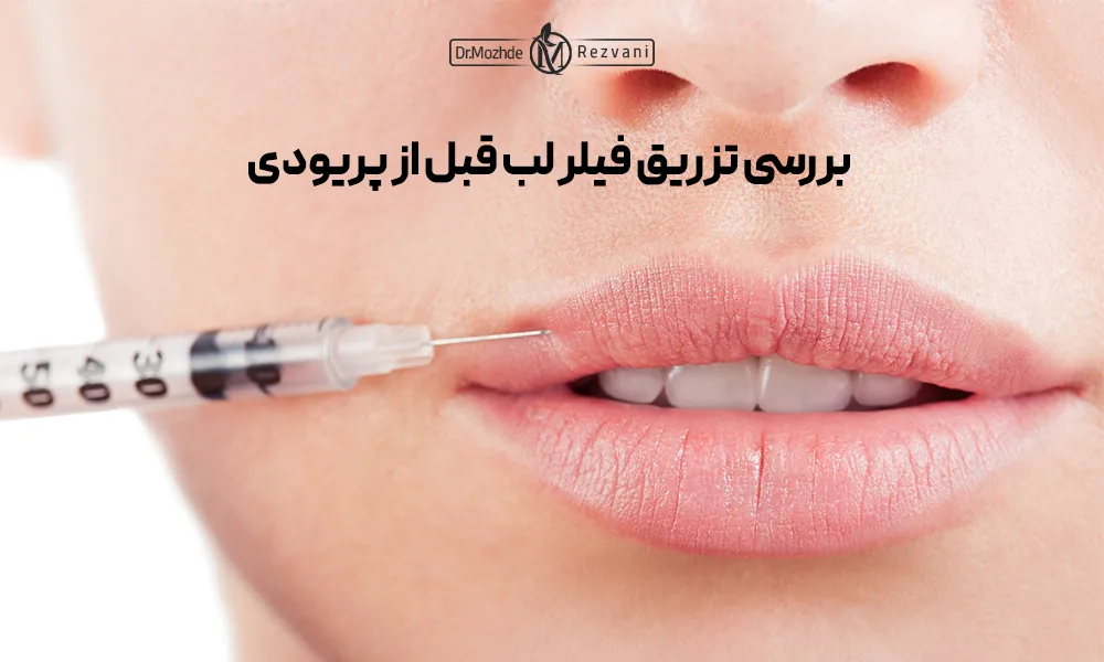 تزریق فیلر لب بالا برای یک خانم قبل از دوران قاعدگی.
