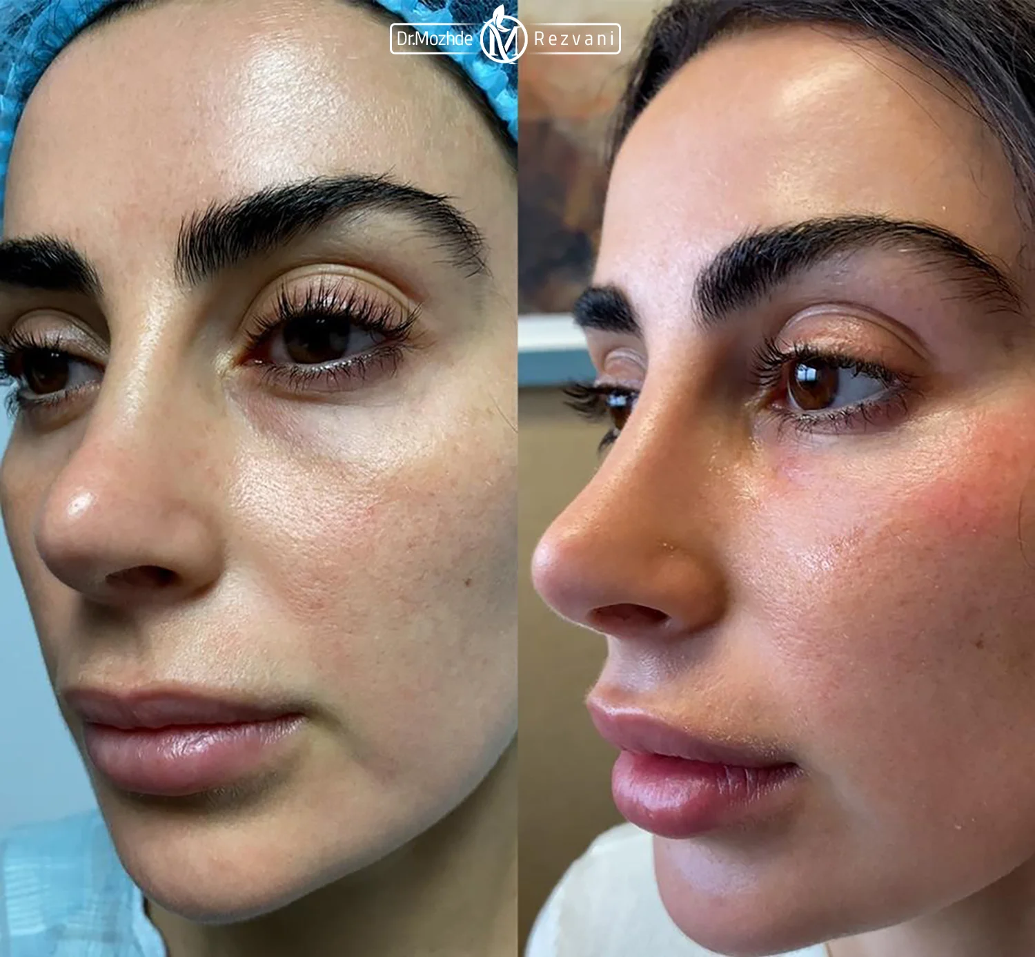 عکس قبل و بعد دختری که زیر چشم خود فیلر تزریق کرده است