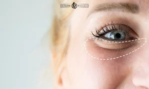 اندولیفت چشم در تهران