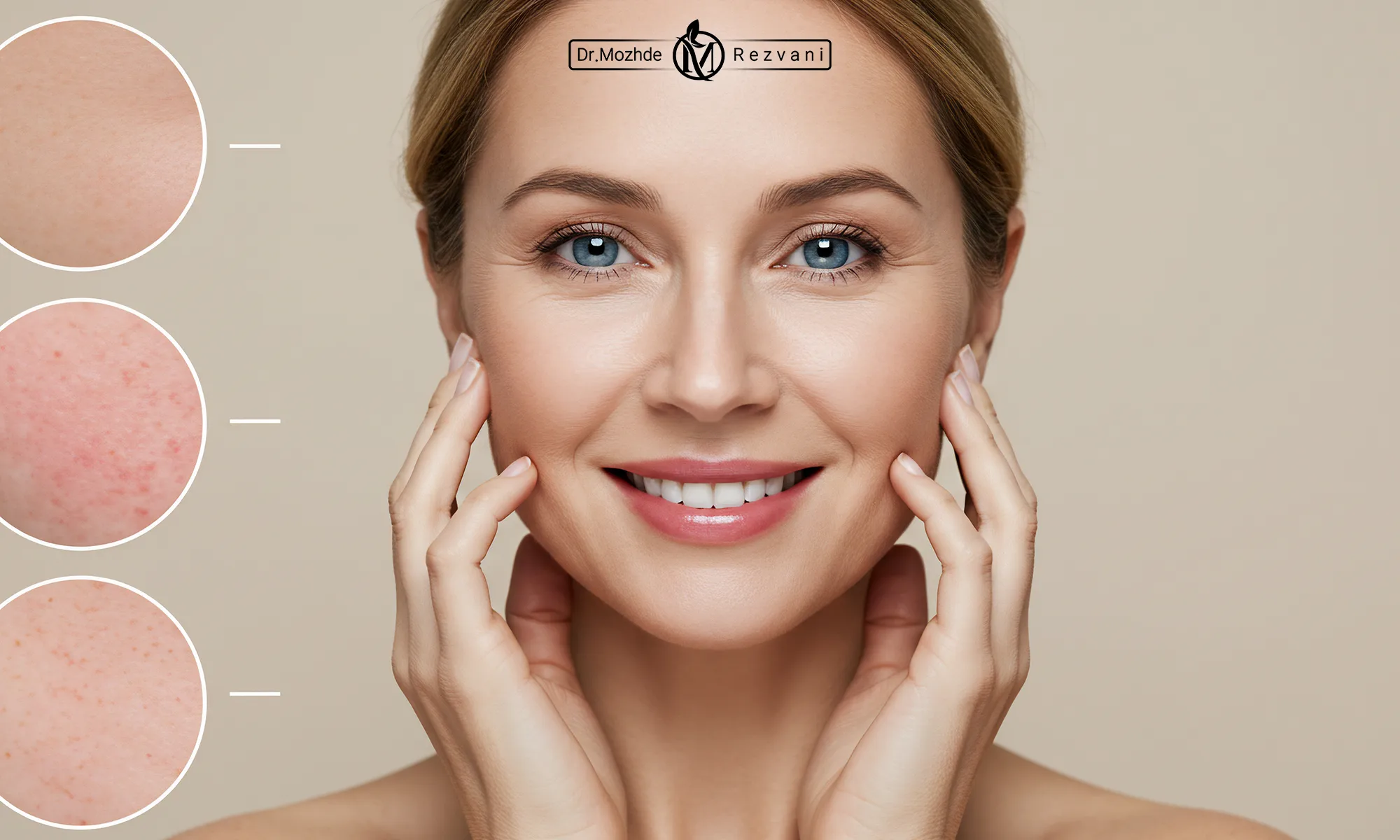 لیفت غبغب و زاویه‌سازی فک با اندولیفت در تهران