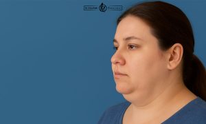 ساکشن غبغب چیست؟ مراحل کامل عمل